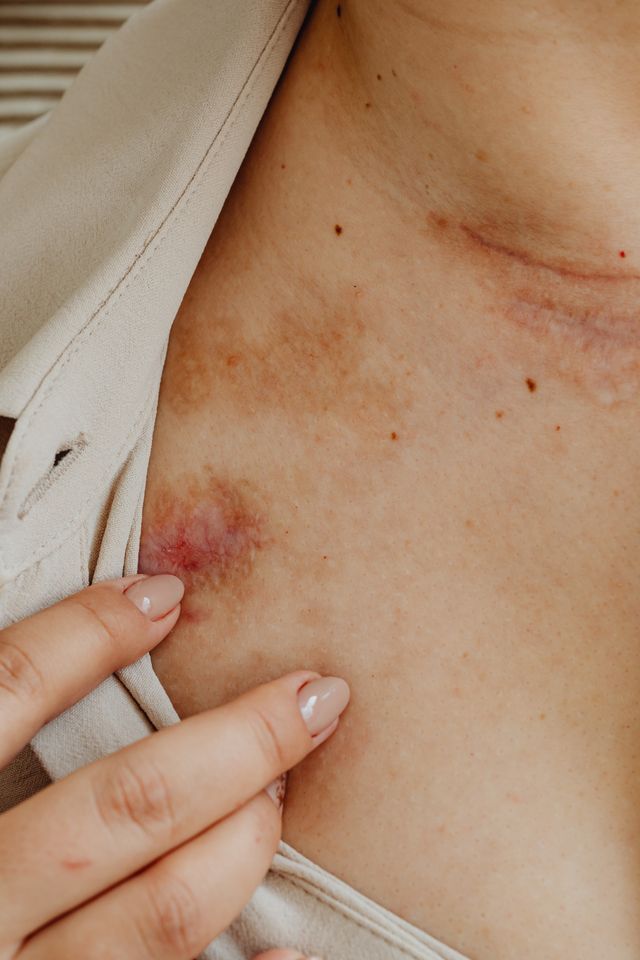 Réaction cutanée après une piqûre de guêpe